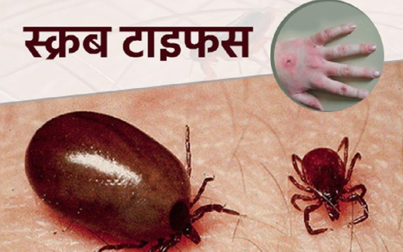 सङ्खुवासभामा स्क्रब टाइफस परीक्षण गर्ने किट अभाव