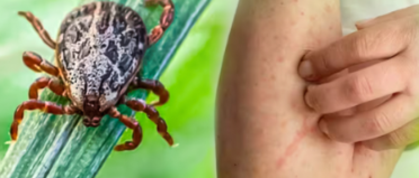 scrub typhus
